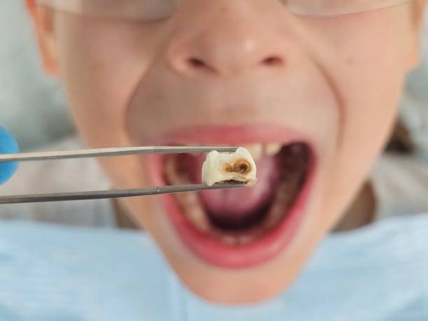 Best Broken or Cracked Tooth Emergency Dentist in Malden, MO